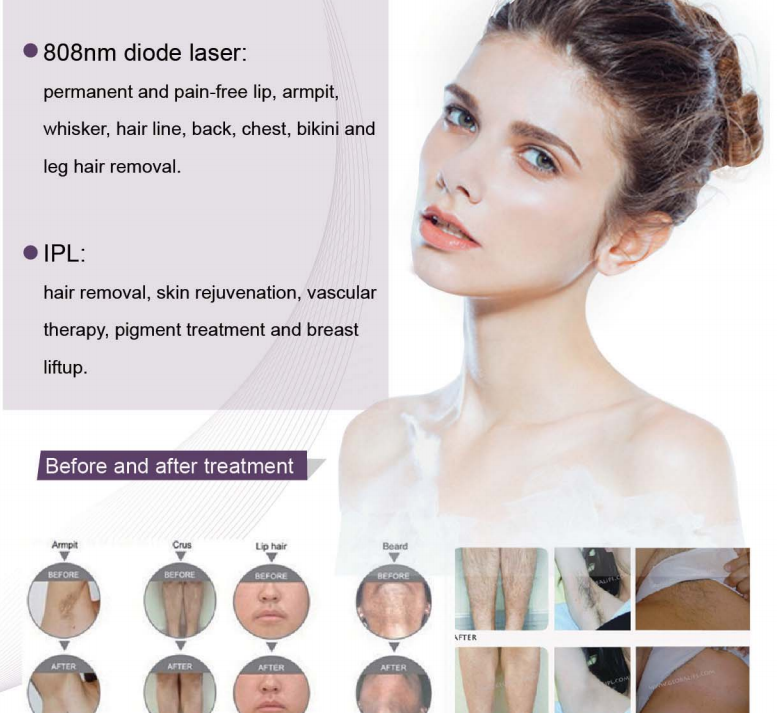 808nm Commercial ipl diode Laser Hair Removal Machine With Big Spot Size 13×13mm2