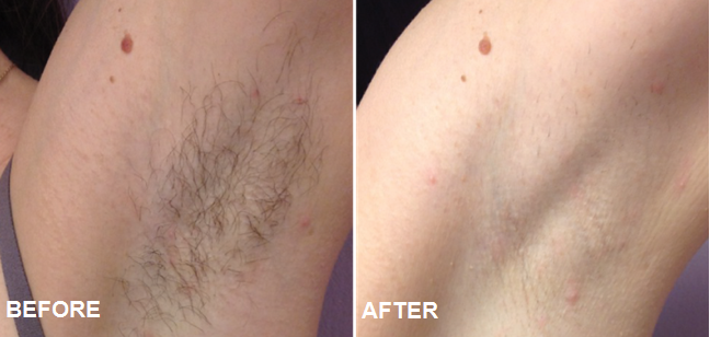 Skin Whiteing IPL Hair Removal Machine For Women , IPL Beauty Equipment