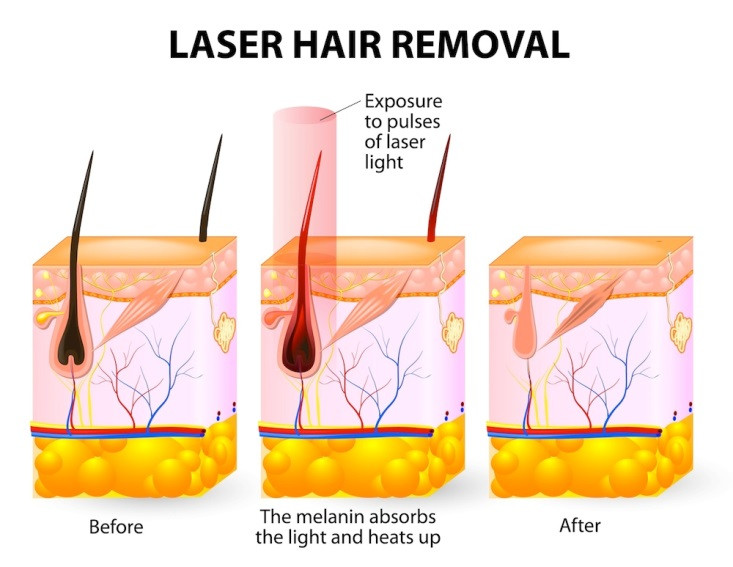 Diode Laser Hair Removal Machine Soprano Titanium 808nm 755nm 1064nm