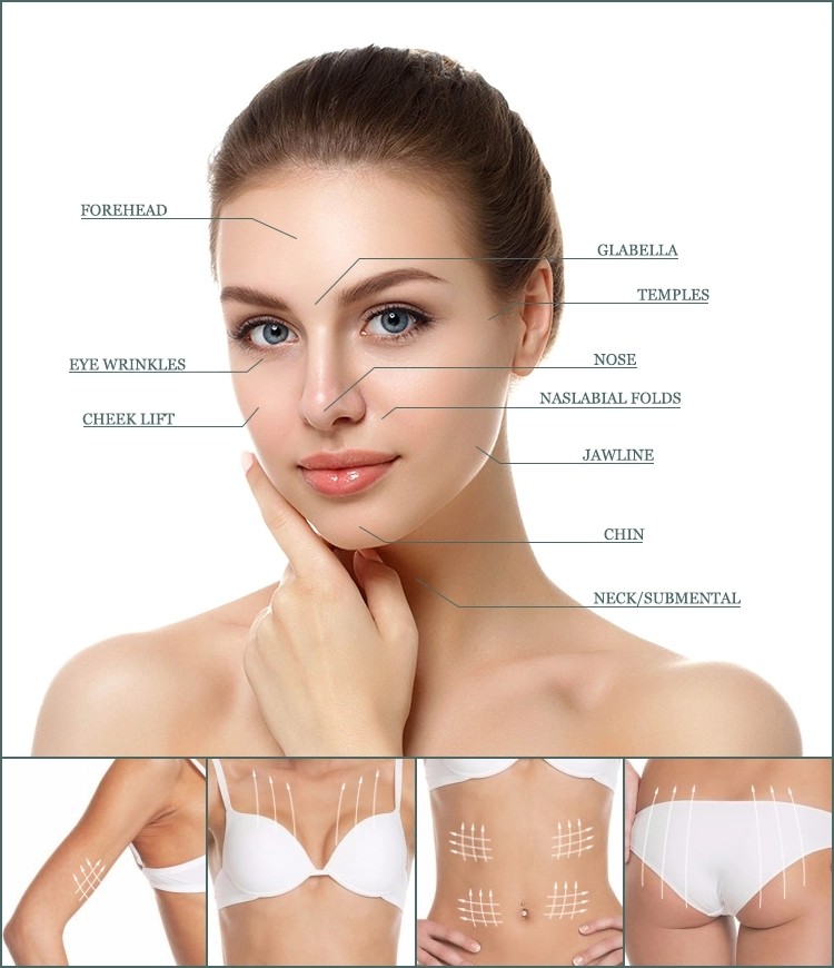 beauty skin care good price v-line magic barbed suture 3d 4d cog 19g 100mm pcl thread lifting korea