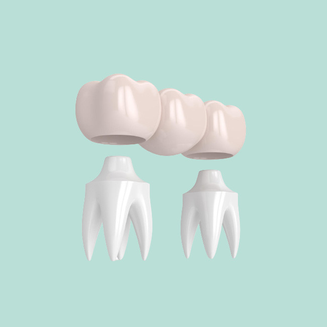 Realistic Appearance Bridges And Dental Crowns Strong Stability Natural Color