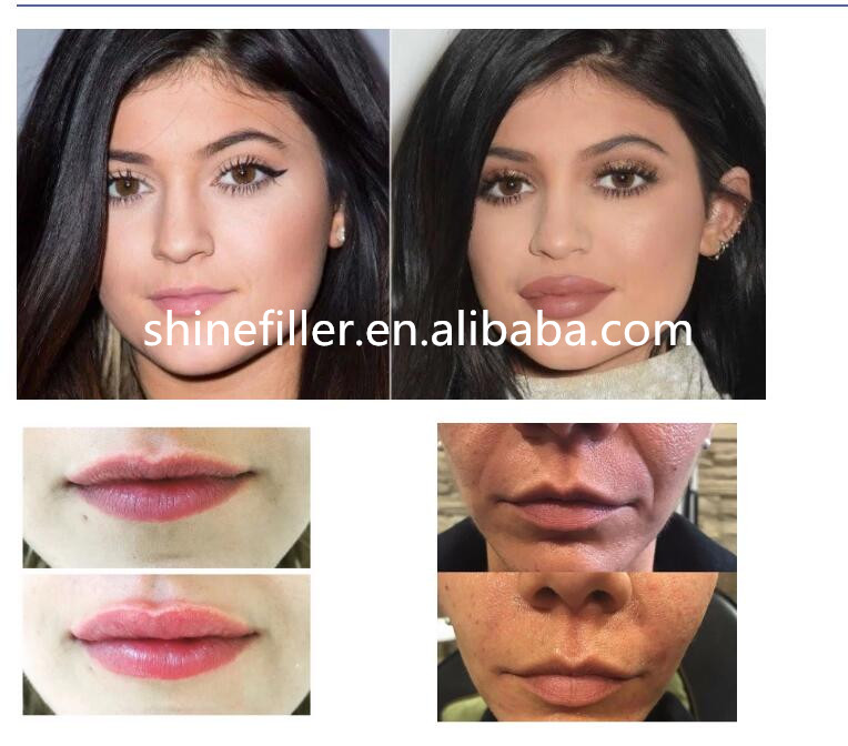 Anti Wrinkles Remover Hyaluronic Acid Filler Injections Ha 1ml For Adult