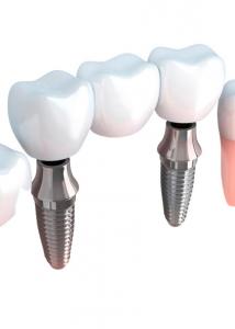 China Realistic Appearance Bridges And Dental Crowns Strong Stability Natural Color on sale