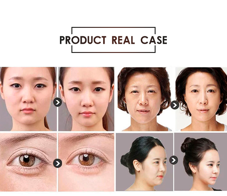 Ultrasonic 4D HIFU Beauty Machine Face Lifting Eye Wrinkle Remover Machine