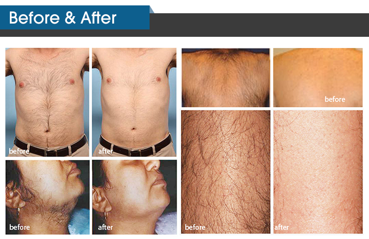 755nm 808nm 1064nm Diode Laser Hair Removal Machine For Clinic / Salons