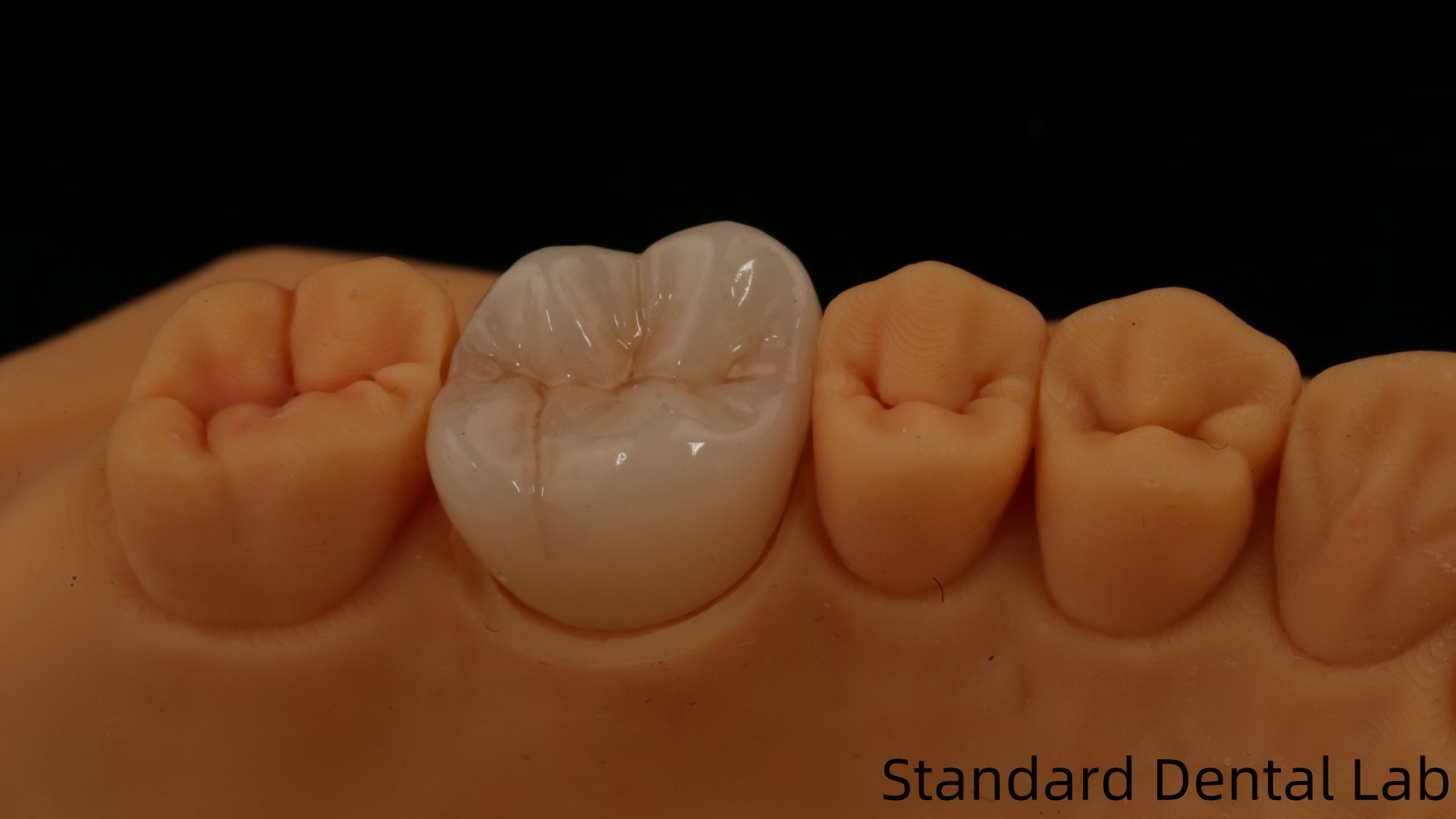 Noritake Porcelain Full Contour Zirconia Crown Customized Vita Shade for Esthetic Digital Dental Restoration by Dental Lab