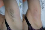 Medical CE Function IPL hair removal IPL Beauty laser machine