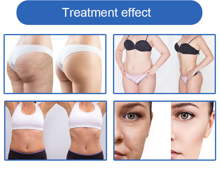 150W RF Cryolipolysis Slimming Machine The Ultimate Fat Freezing Solution with Laser Diode AlGalnp 635-650nm Wavelength