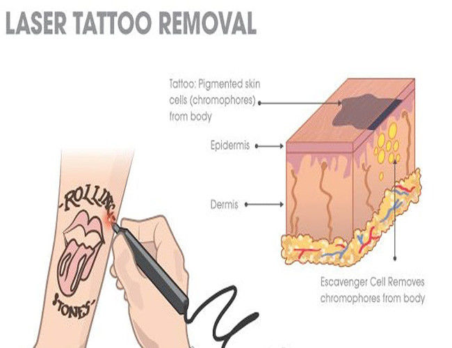 Tattoo Removal ND YAG Laser Machine