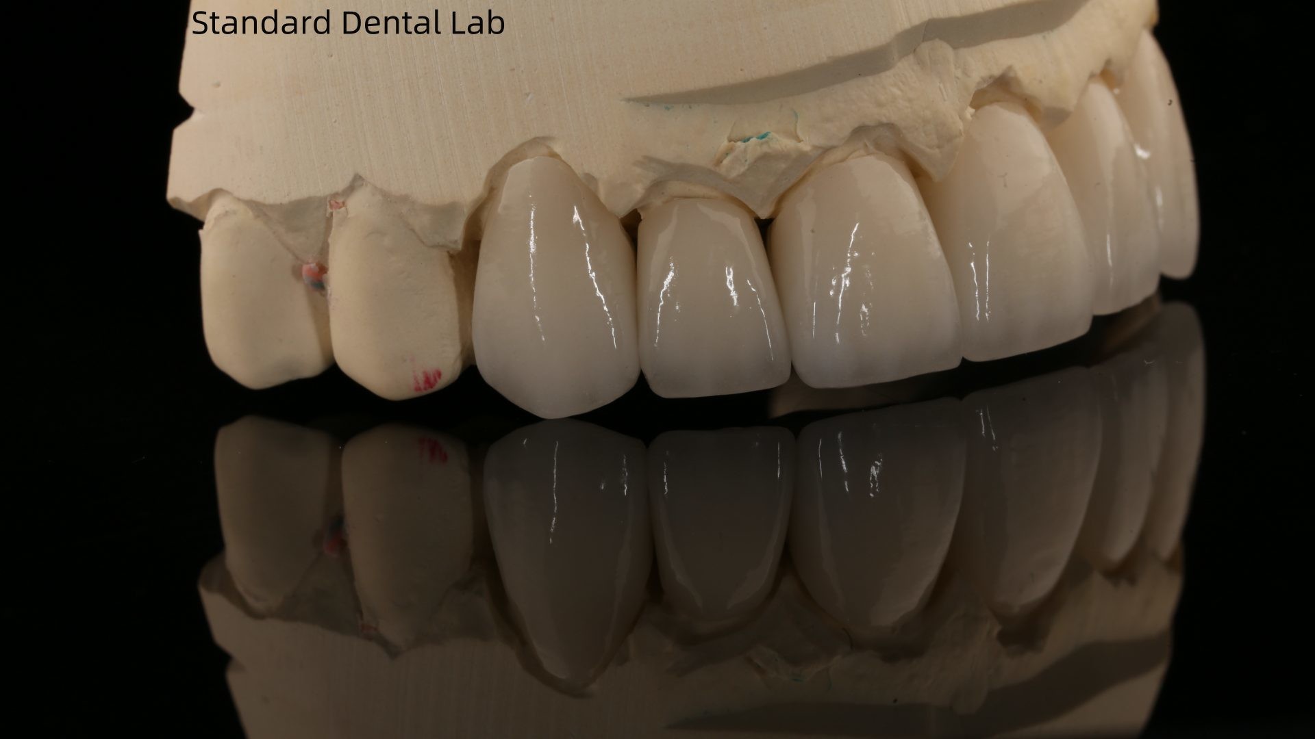 Full Contour Zirconia Crown and High Aesthetic Natural Dental Bridge 5 Year Guarantee
