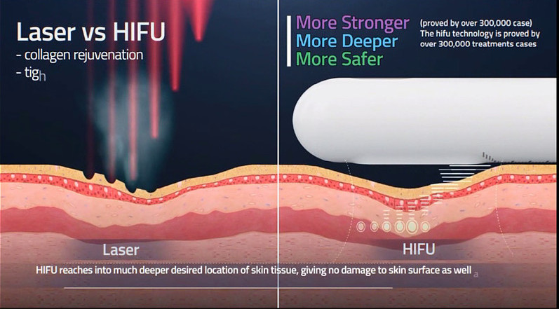 Body And Facial Ultrasound Machine HIFU Hifu Fat Removal Lipo HIFU Sonic