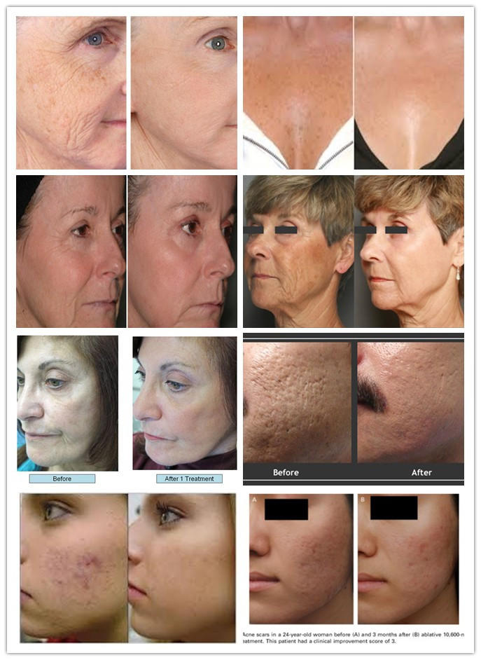 2016 hot selling RF pipe Co2 fractional laser for skin resurfacing and vagina tightening