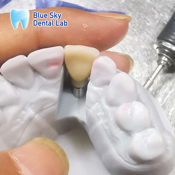 Regular Implant Cases Customizable Single Implant Tooth Offset Arch Implant Case