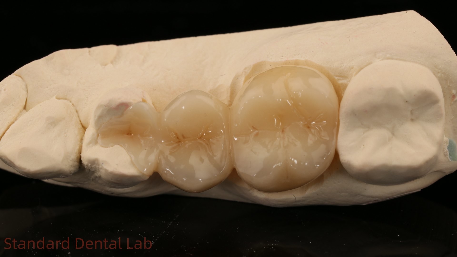Dental Digital Full Zirconia Crown With 3D Print Model SDL Dental Lab Zirconia Onlay