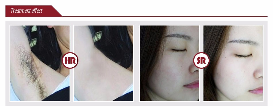 Mejire Opt Shr Ipl Machine , Mini Hair Removal Ipl Photofacial Machine