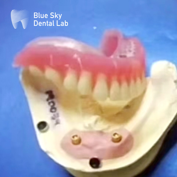 Removable Locator Attachment Implant Overdenture Titanium Upper Locator Denture