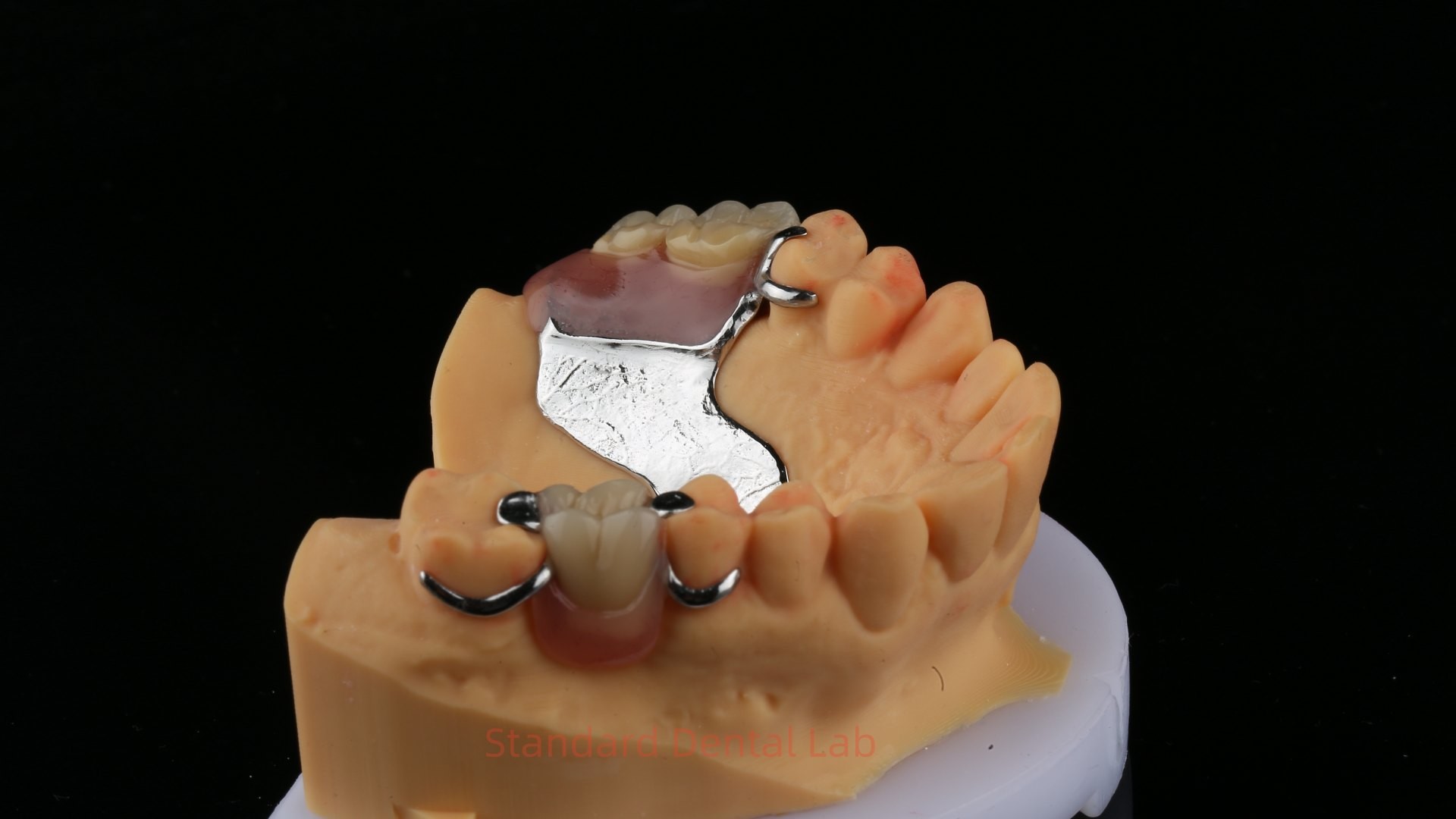 Partial Cobalt Chrome Dentures Ivoclar Scheftner Comfortable Metal Framework Delivered in Just 3 Days