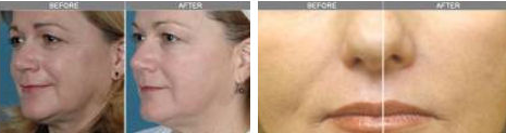 CE Approved Fractional RF Skin Tightening Machine For Skin Rejuvenation
