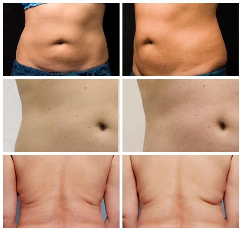4D Body Slimming Machine Freezing Fat 360 Surround Cooling 4 Handles Cryolipolysis