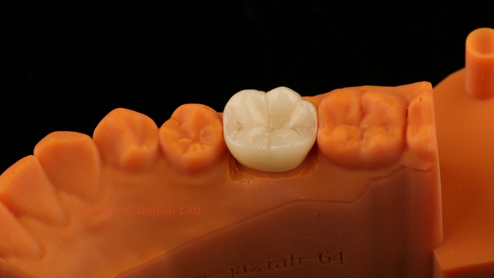 High Aesthetic Full Contour Zirconia Crown with Metal Post Core 5 Years Guarantee and Better Technicians from SDL Dental Lab