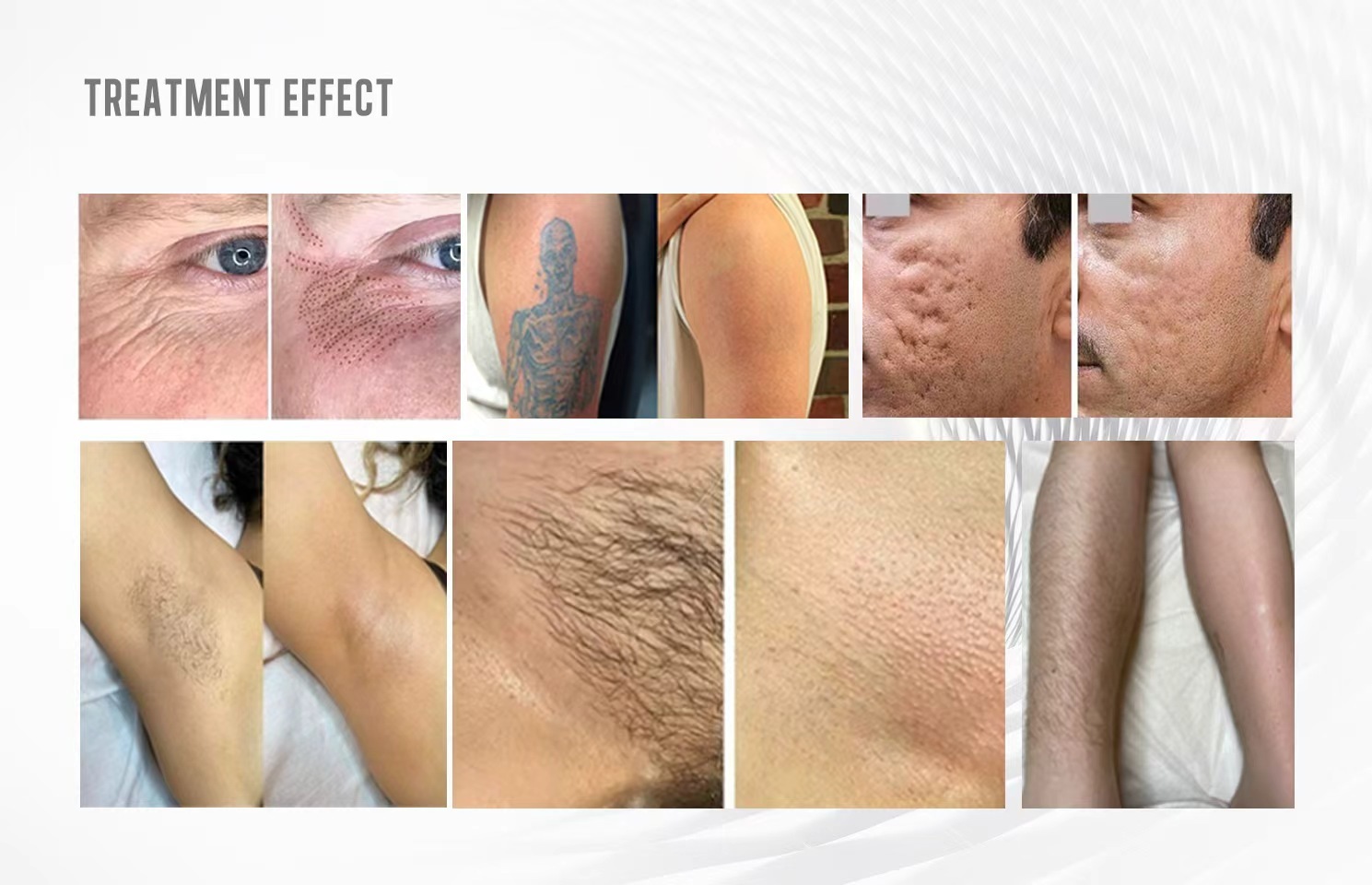 2026 Portable Diode Laser 808nm Painless Hair Removal Nd Yag Pico Laser Tattoo Removal Machine