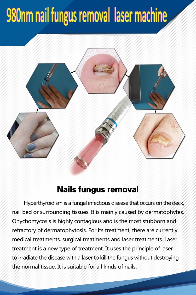 spider veins vascular vein removal nail fungus 980nm diode laser therapy machine for toe nail fungus treatment