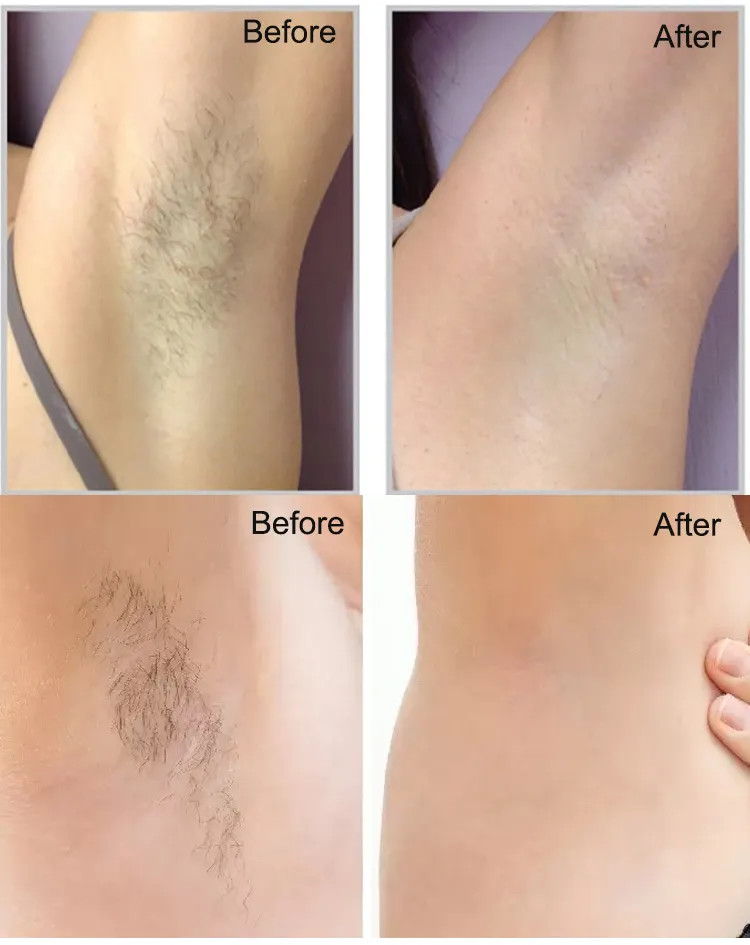 Non Pain 808nm Diode Laser Hair Removal Machine 400ms Pulse Width