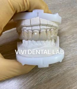 Quality Precise Dental Lab Crowns Esthetic Porcelain Zirconia Tooth Crown for sale