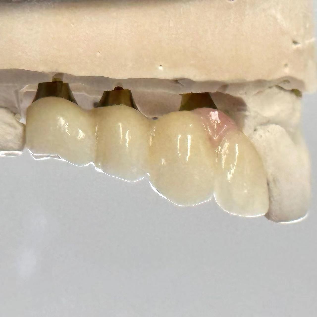 Porcelain Zirconia Cement Retained Screw Implant Hexagonal Head Shape for Custom Fit Esthetics