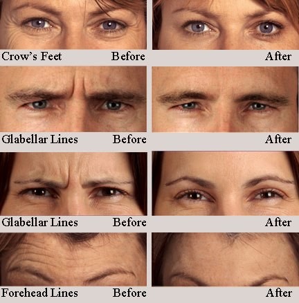 BTX Injection Type A 100 Units Botulinum Toxin Cosmetic Use