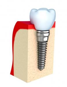 China Dentures Temporary Dental Implant Bar Single All Ceramic Teeth on sale