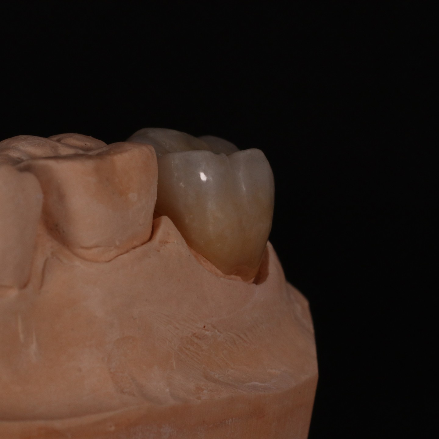 Full Contour Translucent Zirconia Crown for Aesthetically Pleasing Results