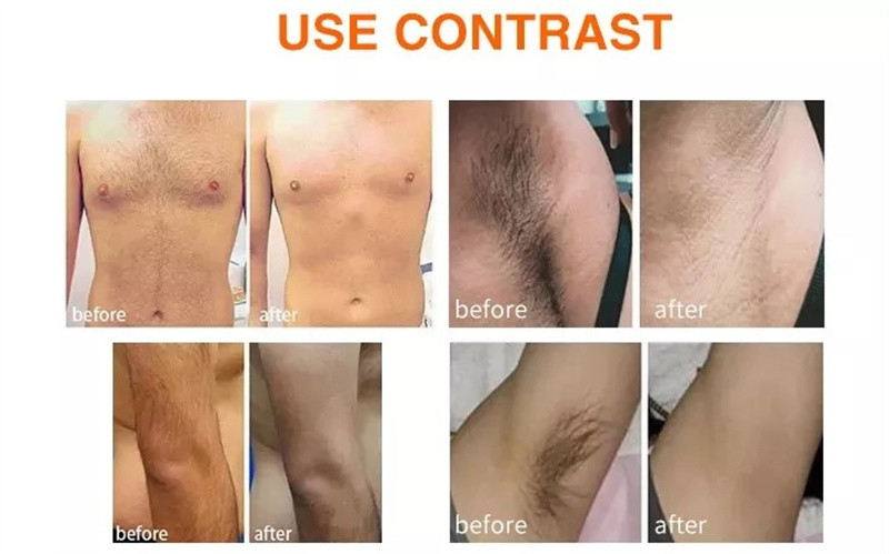 808nm Adjustable Pulse Diode Laser Machine For Hair Removal