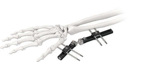 Orthopedic Wrist External Fixator Standard Single sided Integrated