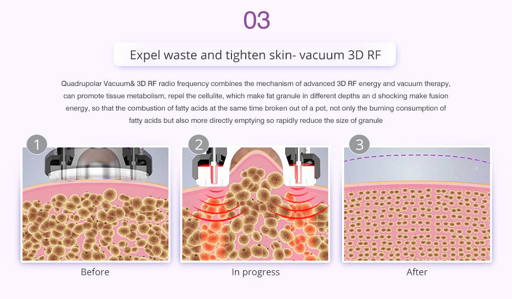 Unoisetion 6 In 1 40k Cavitation Ultrasonic Lipo Laser Body Sculpting Machine