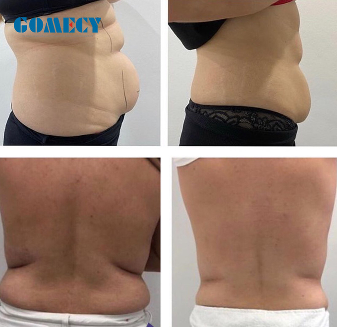Lipo Sculpting Machine 209mw Diode Laser Fat Reduction System With 8 Paddles