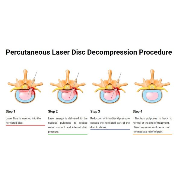 1470nm PLDD Laser Machine Spinal Disc Decompression