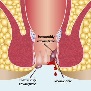 810nm Laser Machine For Hemorrhoids