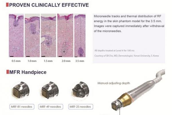 Microneedle therapy system fractional microneedle radiofrequency micro needling acne scars
