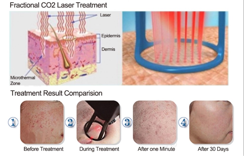 Portable CO2 Laser Fractional Machine 40W For Beauty Salon 2 Years Warranty