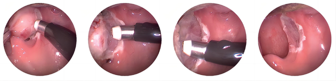 ENT RF Plasma Surgical System Cryogenic Surgical Device