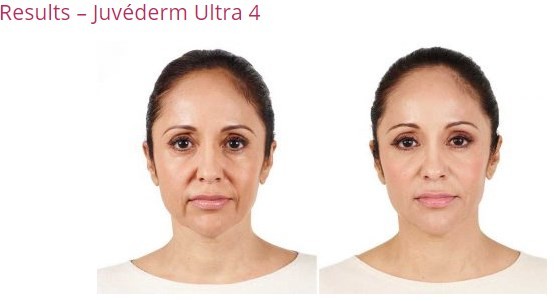 Lip Fullness Juvederm Ultra4 Allergan Dermal Filler Juvederm HA Fillers For Lips