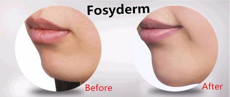 Eco Friendly Dermal Filler Medical Sodium Hyaluronate Gel For Removing Neck Lines