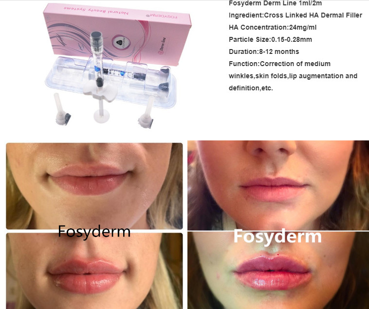 Transparent HA Injectable Volume Hyaluronic Dermal Filler For Face With Syringe