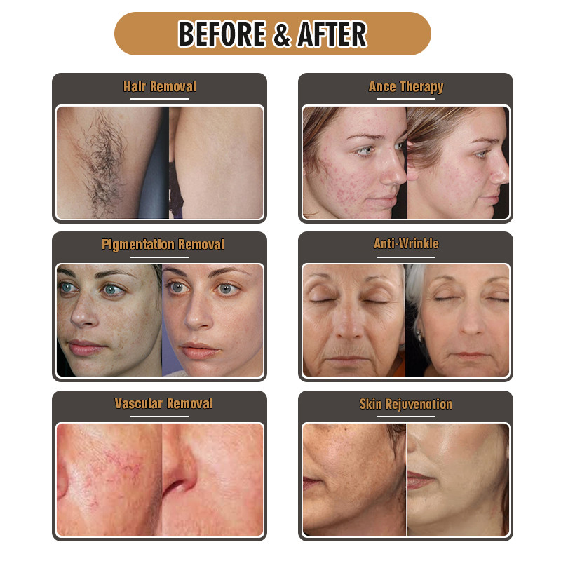 CE FDA Ipl Shr Laser Hair Removal Machine 220v 110v