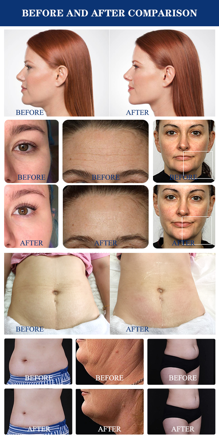 Crioterapia Cavitation RF Vacuum Slimming Machine Wrinkle Remover