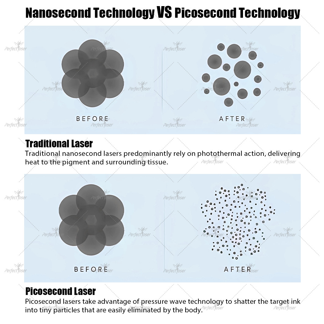Professional Picosecond Laser Tattoo Removal Machine with Nd.yag Laser and 2000w Power
