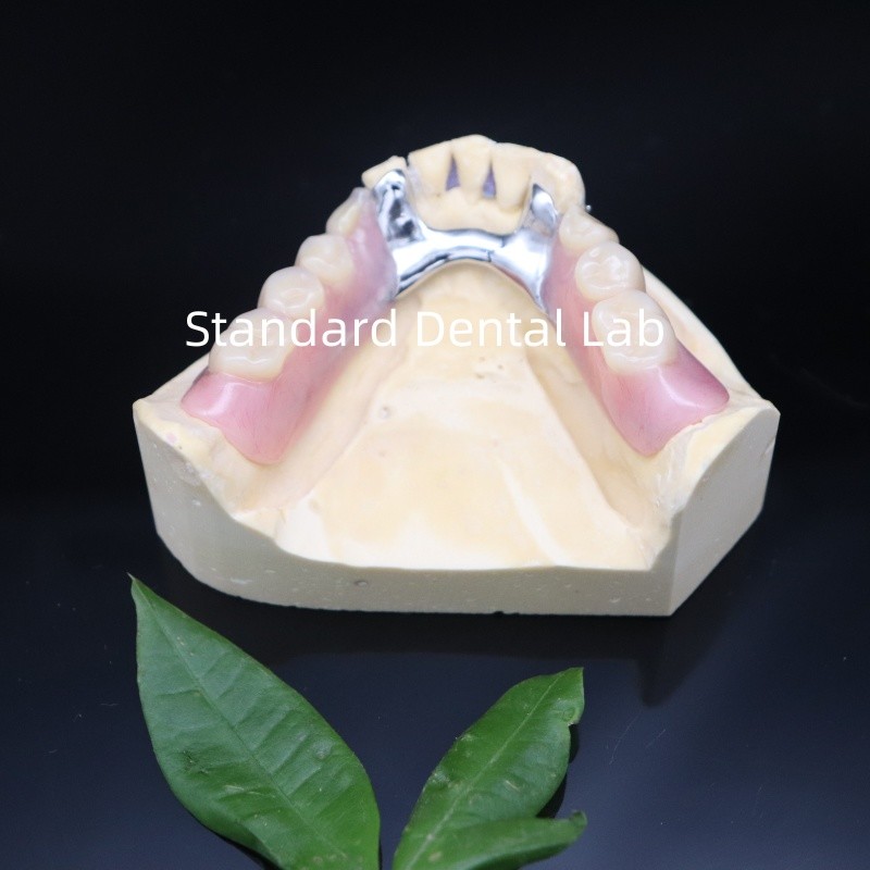 Acrylic Metal Partial Denture Frameworks High Esthetics SDL dental lab