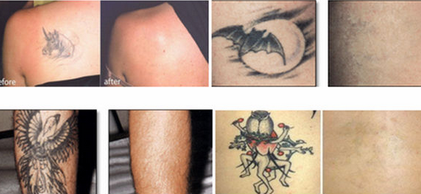 Professional Q Switched Nd Yag Laser tattoo removal machine with touch screenr