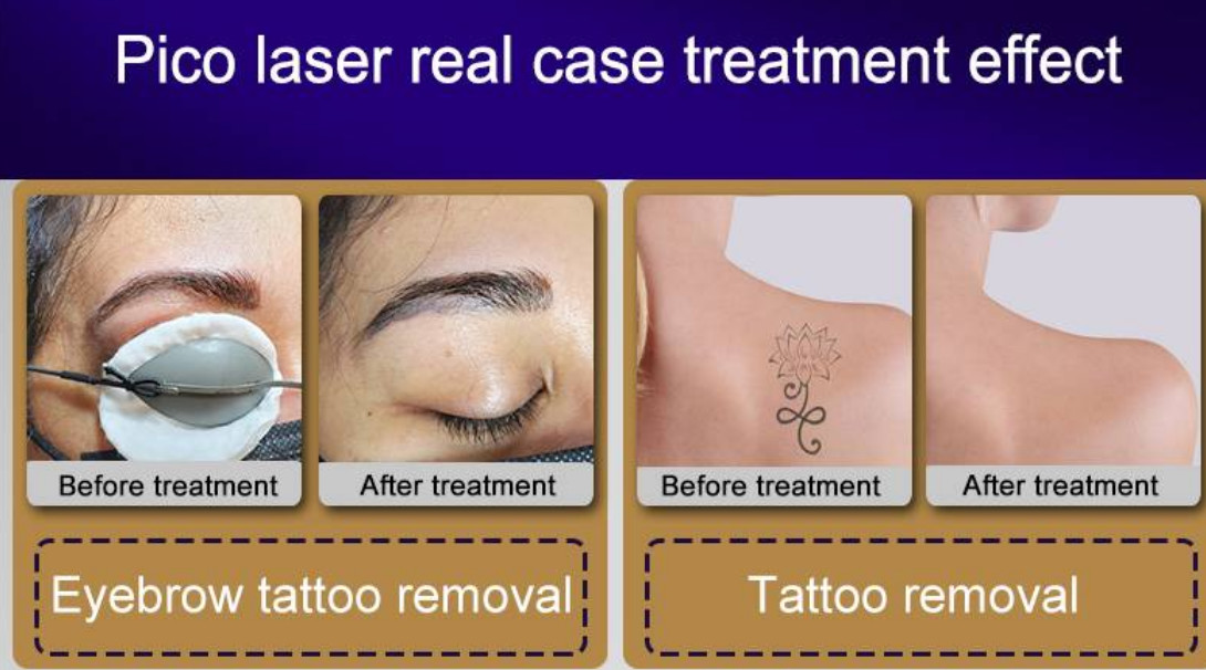 810nm Depiladora Titanium Diod Laser Beauty Machine 3 Waves Remove Hair Pico Laser Tattoo Removal